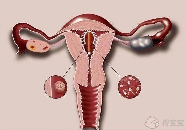 宫内节育器对你的身体有多危险？出于健康原因，你真的不应该放置宫内避孕器吗？